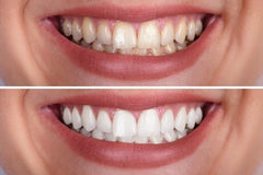 Dr Dent Teeth Whitening Strips