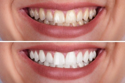 Dr Dent Teeth Whitening Strips