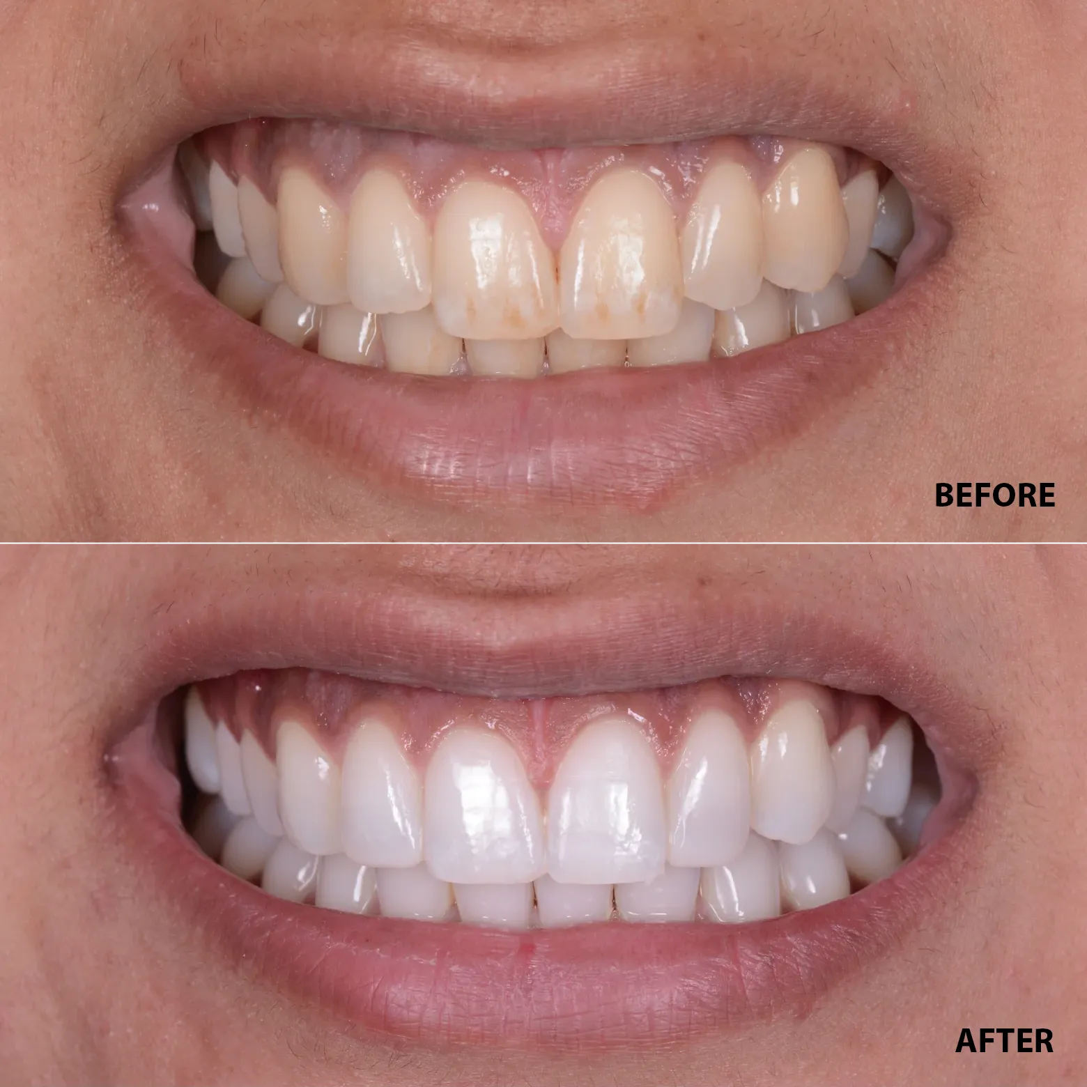 Dr Dent Teeth Whitening Strips